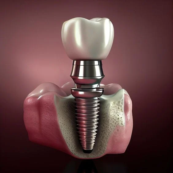 dental implants